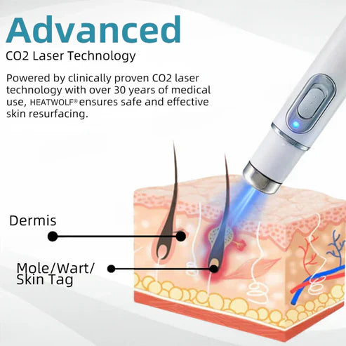Non Invasive Mole and Wart Removal Pen