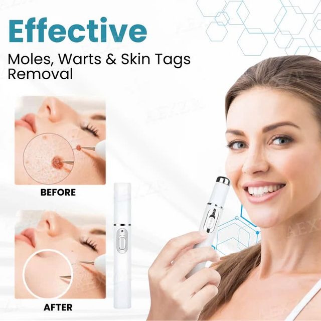 Non Invasive Mole and Wart Removal Pen